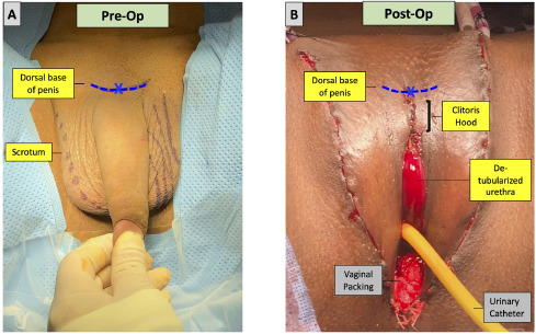 how to remove hair from pennis permanently