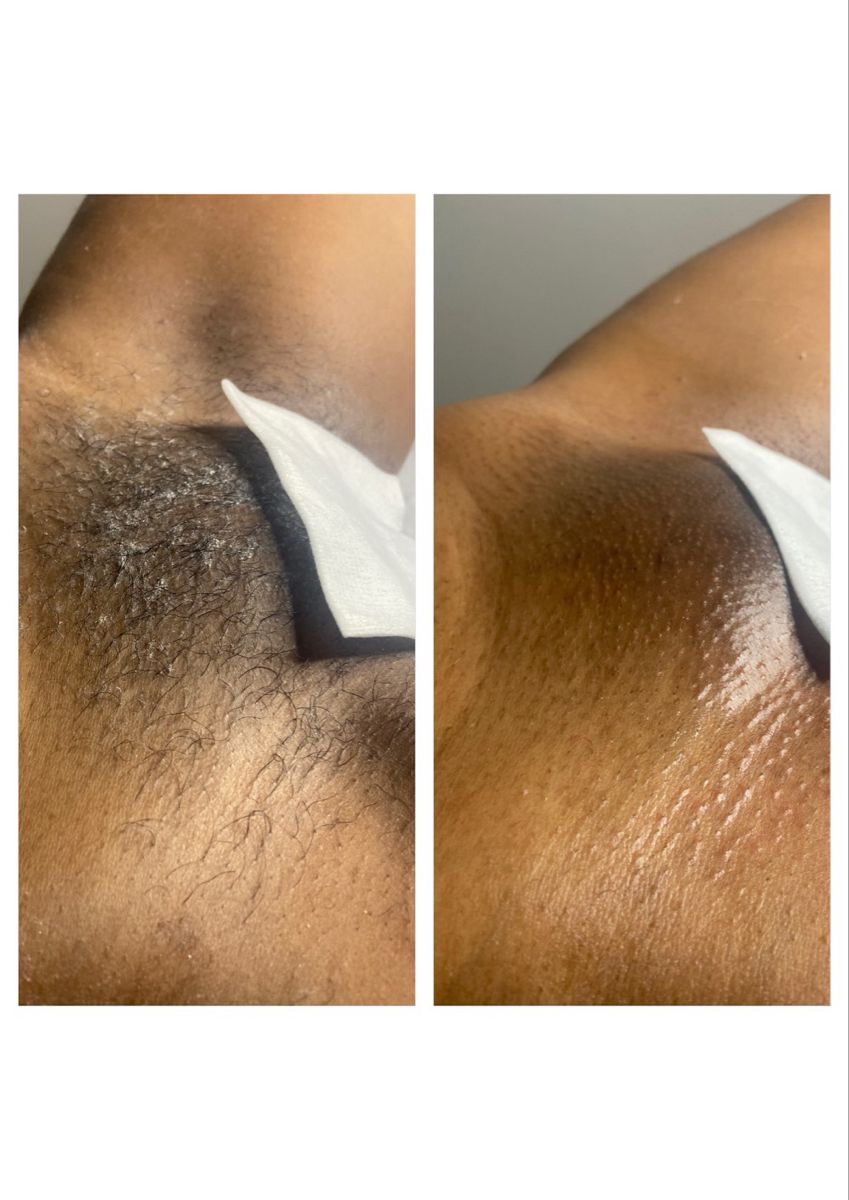 Brazilian Wax Pictures Before And After Male girls monika
