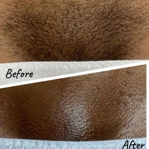 andrew baas recommends brazilian wax pictures before and after male pic