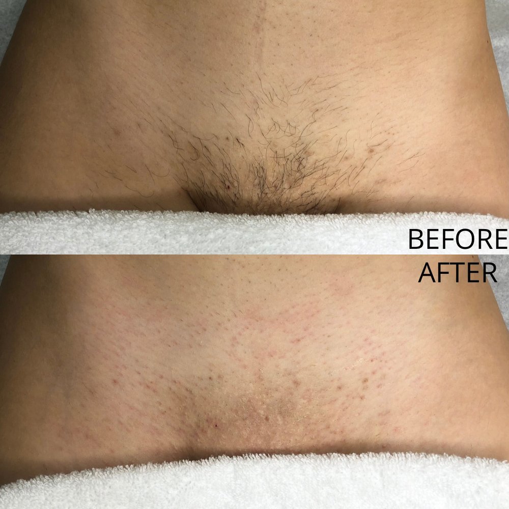 brazilian wax before and after pictures