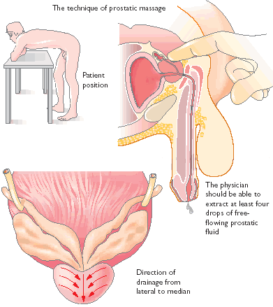 deepika david recommends external prostate massage techniques pic