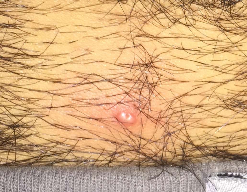 danny eady recommends ingrown hair on my penile shaft pic