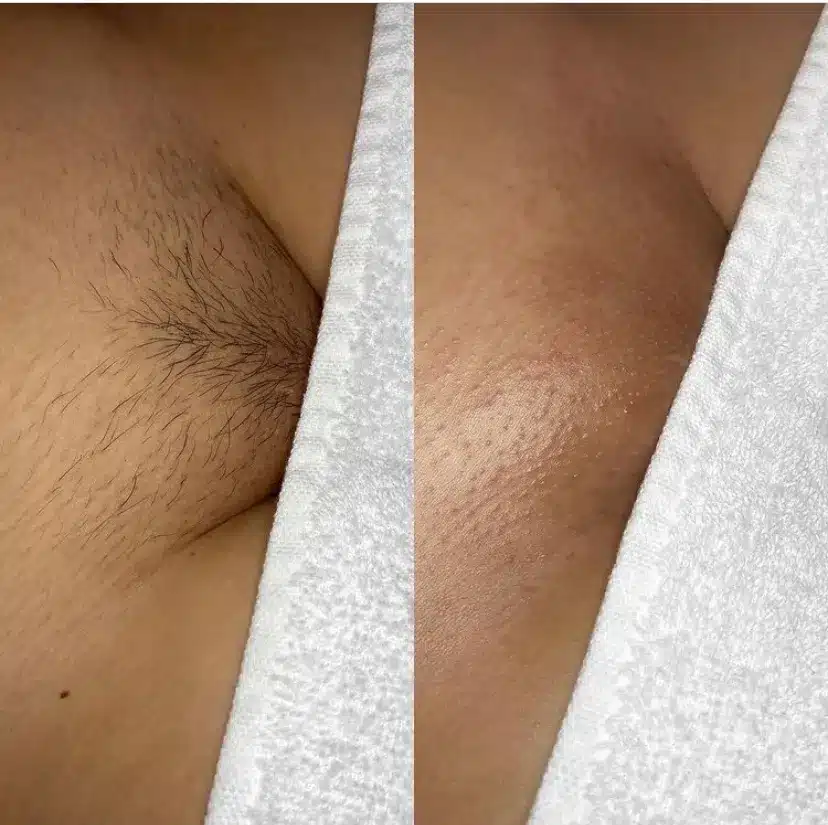 debbie murchison recommends brazilian wax before and after pictures pic