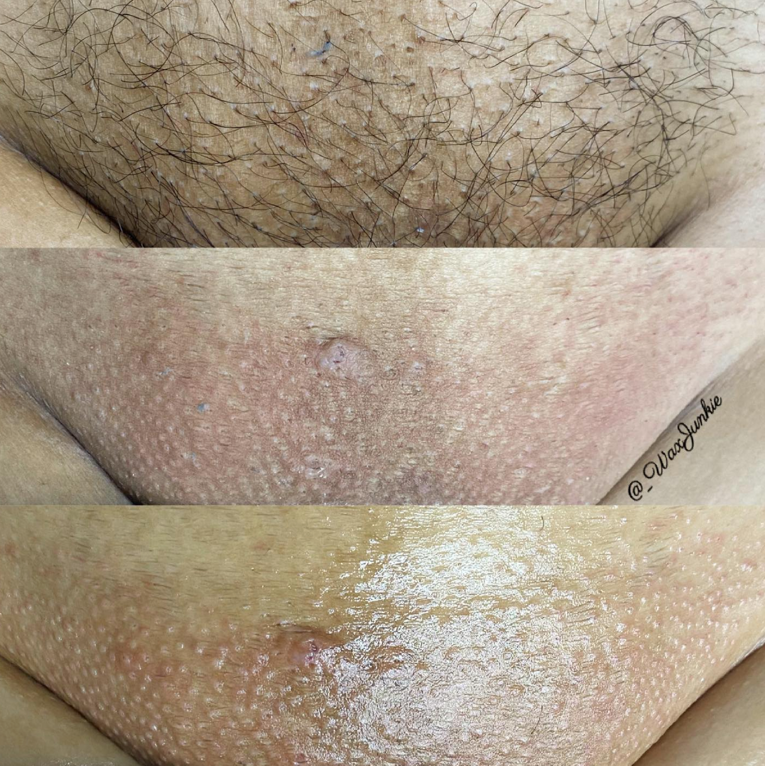 Best of Brazilian wax before and after pictures