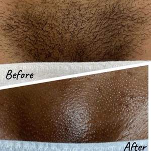 aimee alderson add photo brazilian wax pictures before and after male