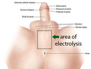 charles palardy recommends how to remove hair from pennis permanently pic