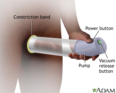 donald kees add how to make a home made penis pump photo