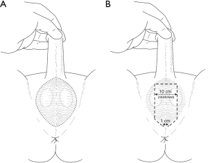 cesar espinal recommends How To Remove Hair From Pennis Permanently