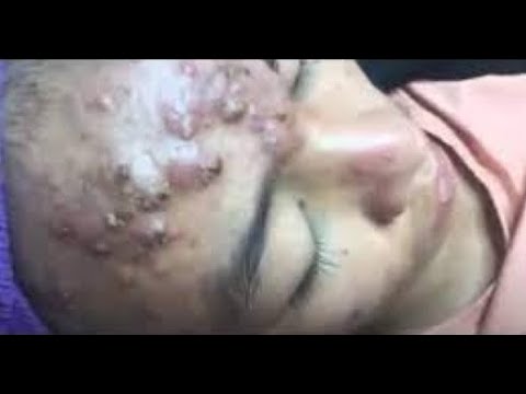 Popping Pimples In Private Area Video an orgasm